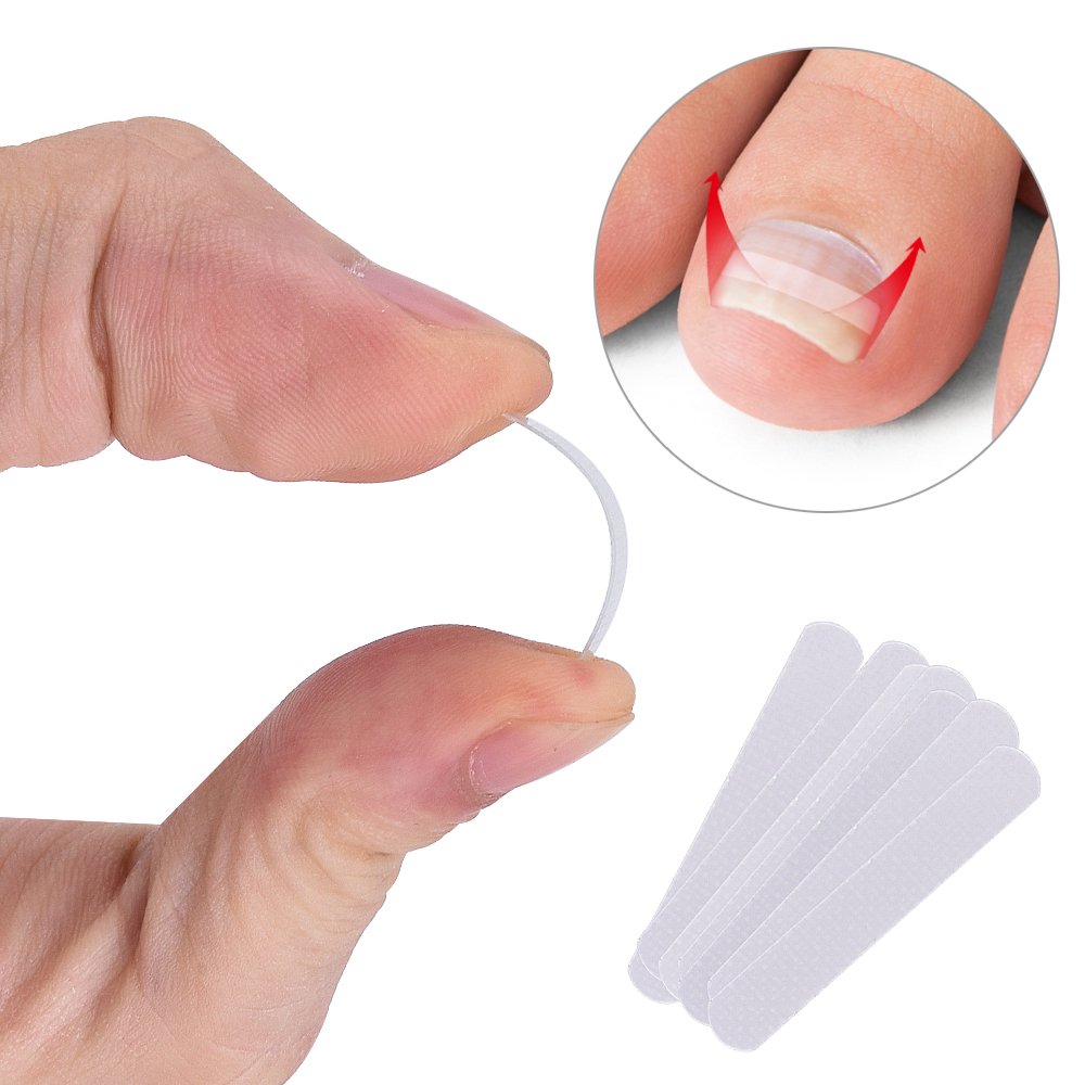 Ingrown toenail corrector strips