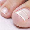 Ingrown toenail corrector strips